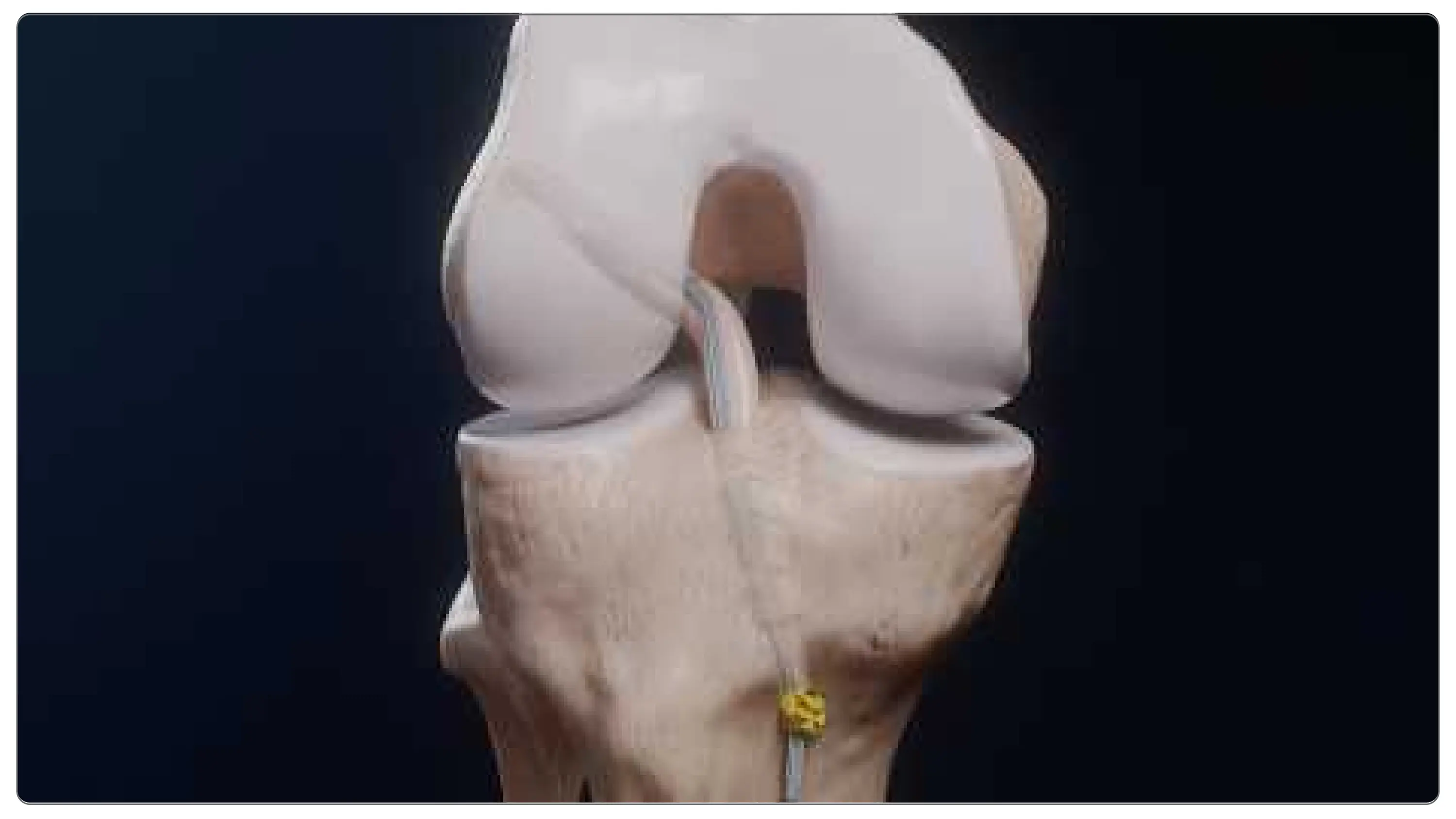 Arthrex ACL Suture Implant