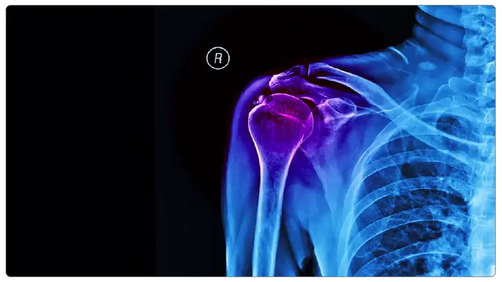 Arthroplasty 