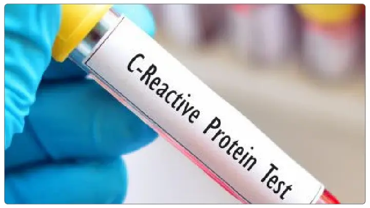 C Reactive Protein(CRP) Testing