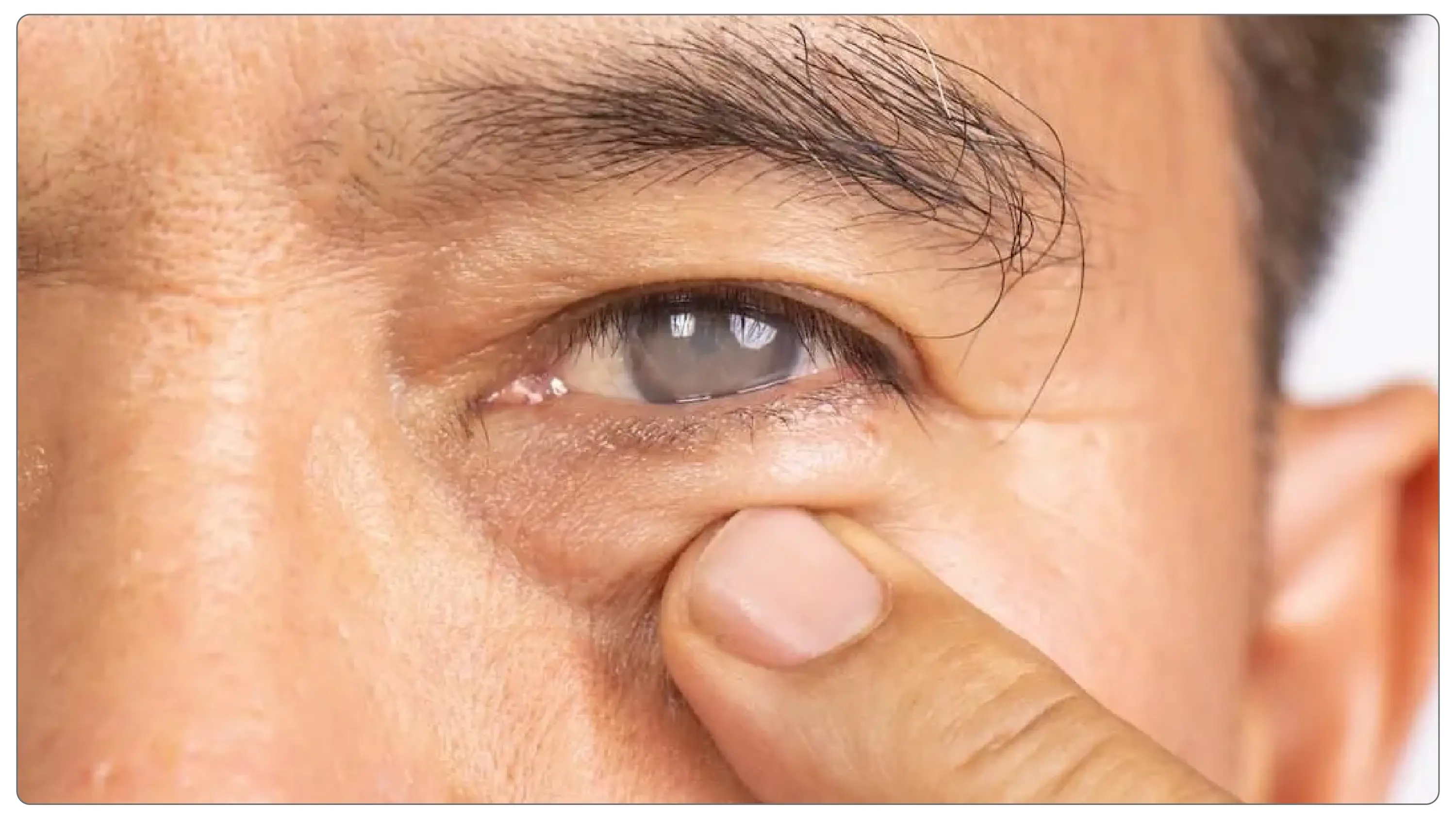 Glaucoma Drainage Device