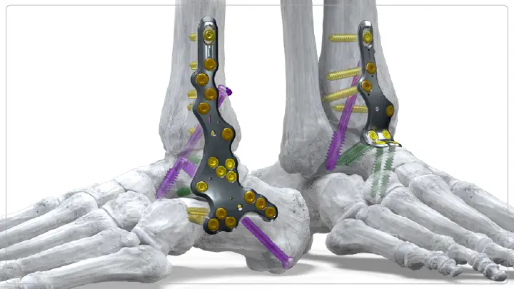 Paragon 28 Showcases Foot and Ankle Advances at ACFAS