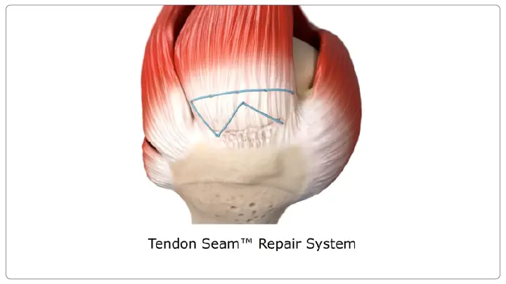 Rotator Cuff Repair